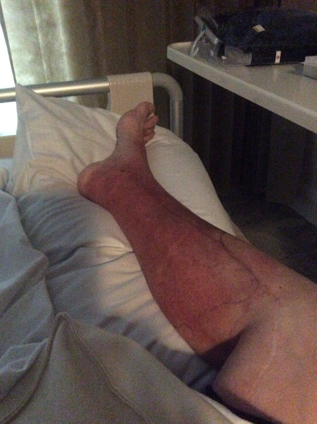 Poor Quality Landing Gear&nbsp;Legs